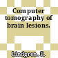 Computer tomography of brain lesions.